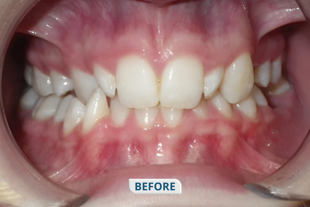 Before treatment at Namira Oro Dental Care
